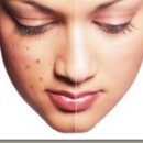 Como disminuir el Acne